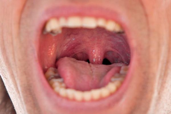 Ожог горла: симптомы, первая помощь и лечение