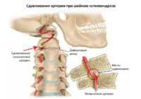 Методы устранения синдрома позвоночной артерии при остеохондрозе