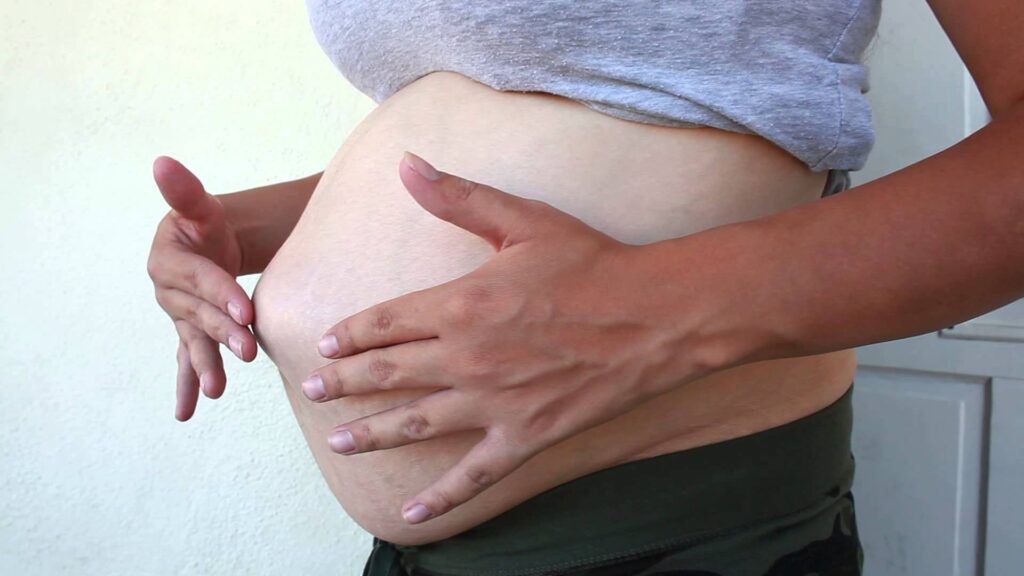 Пупочная грыжа во время беременности