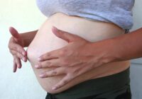 Пупочная грыжа во время беременности