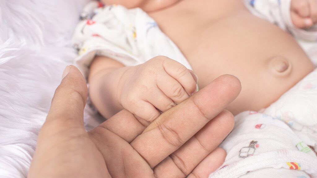 Симптомы и лечение пупочной грыжи у новорожденных