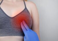 Синяк на груди или гематома молочной железы