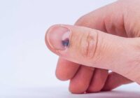 Методы устранения гематомы под ногтями пальцев