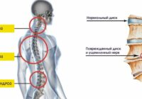 Особенности выявления и лечения поясничного остеохондроза