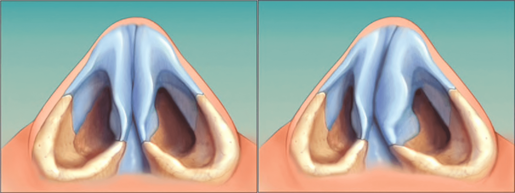 Последствия гематомы перегородки носа