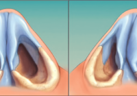 Последствия гематомы перегородки носа