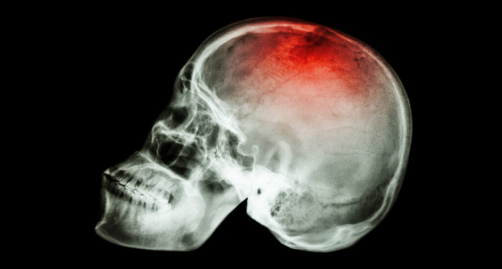 Перелом свода черепа – серьёзное повреждение, требующее незамедлительной квалифицированной помощи