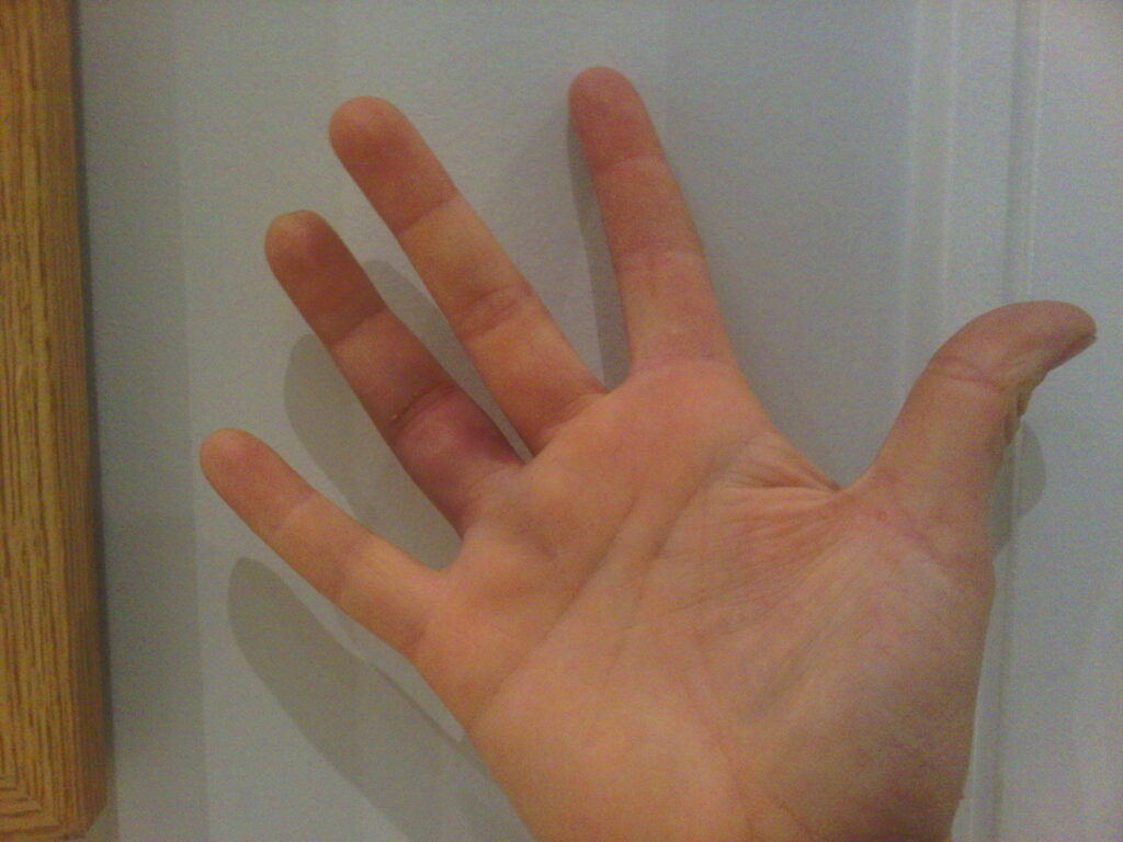 Особенности переломов пальца на руке