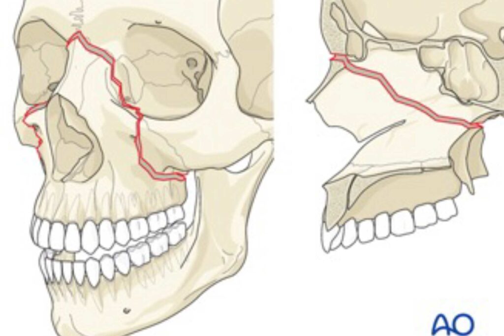 Особенности перелома верхней челюсти