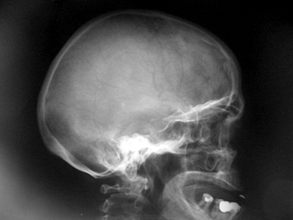 Перелом черепа — симптомы травмы, лечение и последствия