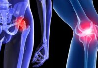 Артроз коленного сустава: причины, симптомы, методы лечения