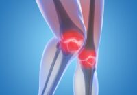 Остеоартроз коленного сустава: симптомы, диагностика, методы лечение