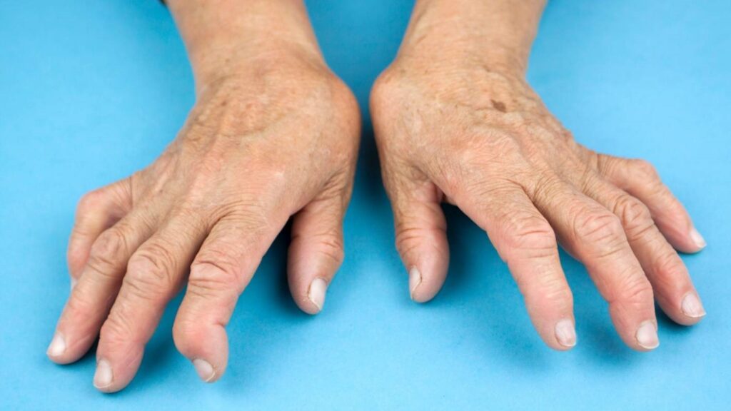 Артрит пальцев рук: виды, причины, симптомы и методы лечения