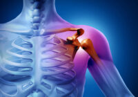 Артрит плечевого сустава: способы лечения и профилактики