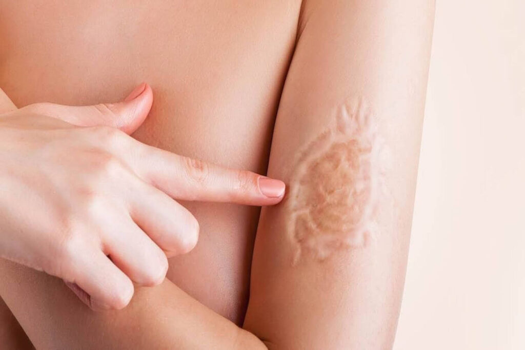 Как убрать шрам от ожога: все способы борьбы с дефектами кожи