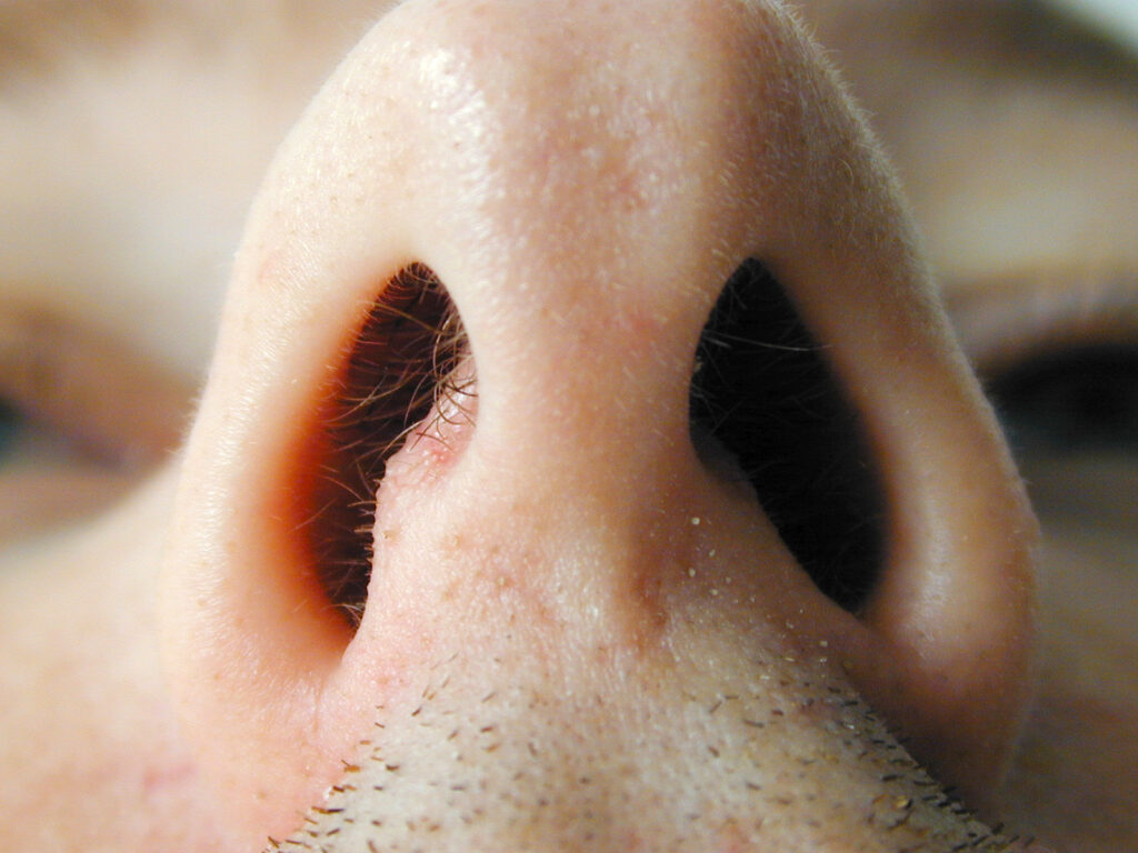 Ожог слизистой носа: причины, симптомы, методы лечения
