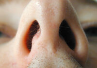 Ожог слизистой носа: причины, симптомы, методы лечения