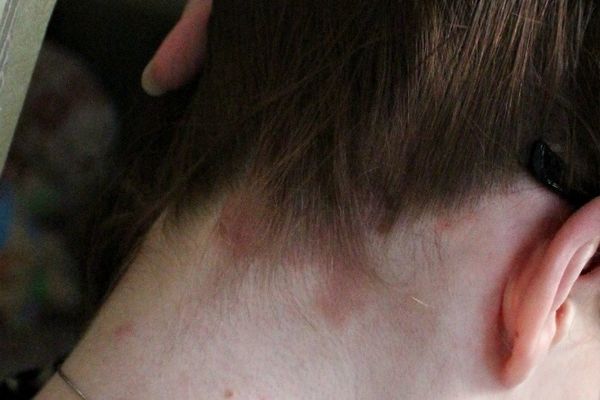 Химический ожог кожи головы при окрашивании лечение народными средствами thumbnail
