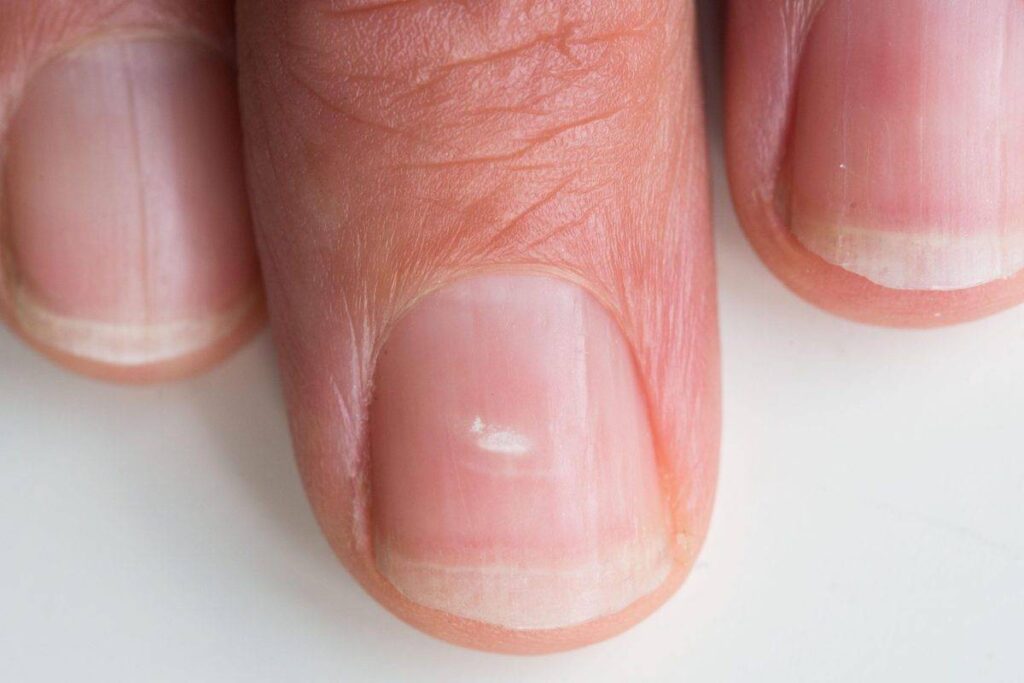 Почему появляются белые пятна на ногтях