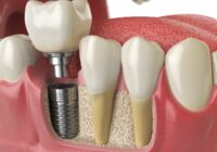 4 причины установить зубной имплант